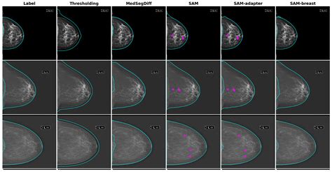 Heightened Breast Cancer Segmentation in Mammogram Images.